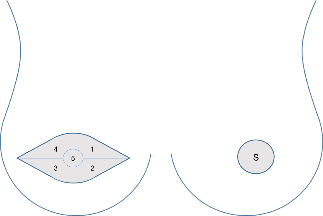 Figure 1: 
The appearance of large skin island on the left and small skin island on the right. Light gray areas depict exposed skin of the flaps. In large skin island, the following regions were tested: 1 – superior medial, 2 – inferior medial, 3 – inferior lateral, 4 – superior lateral, and 5 – central. Small skin island was tested as an unique area herein marked with an S.
