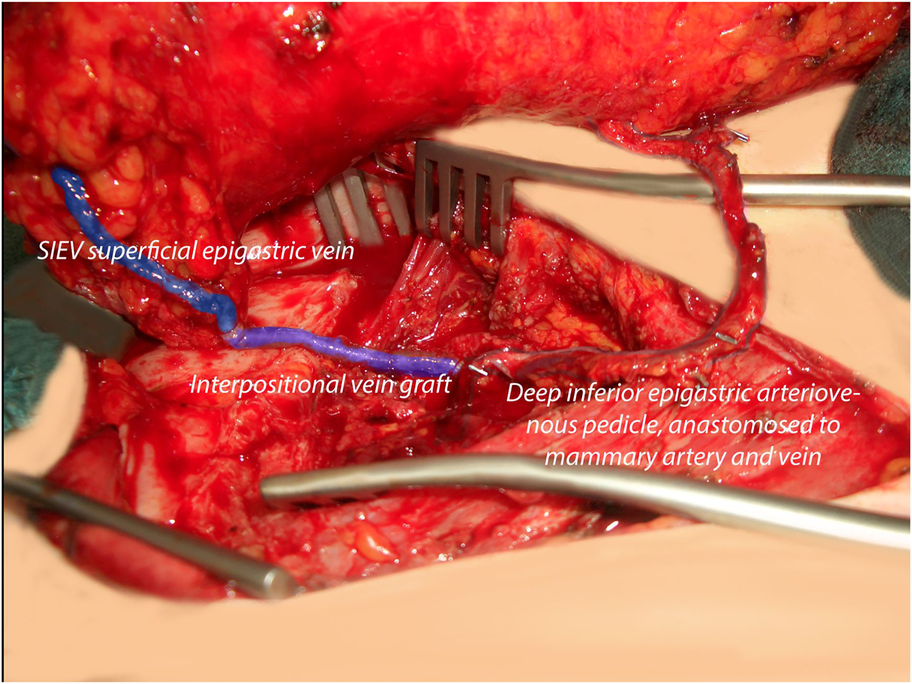 Figure 1: 
Intraoperative site after interpositional vein graft to enhance outflow from the superficial venous system into the deep inferior epigastric system (modified after [33], copyright REH 2025).
