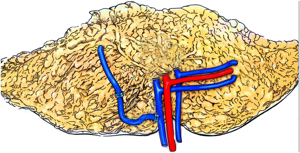Figure 2: 
Schematic rendering of interpositional vein graft to enhance venous drainage from the superficial epigastric vein to the deep epigastric vein (copyright REH 2025).