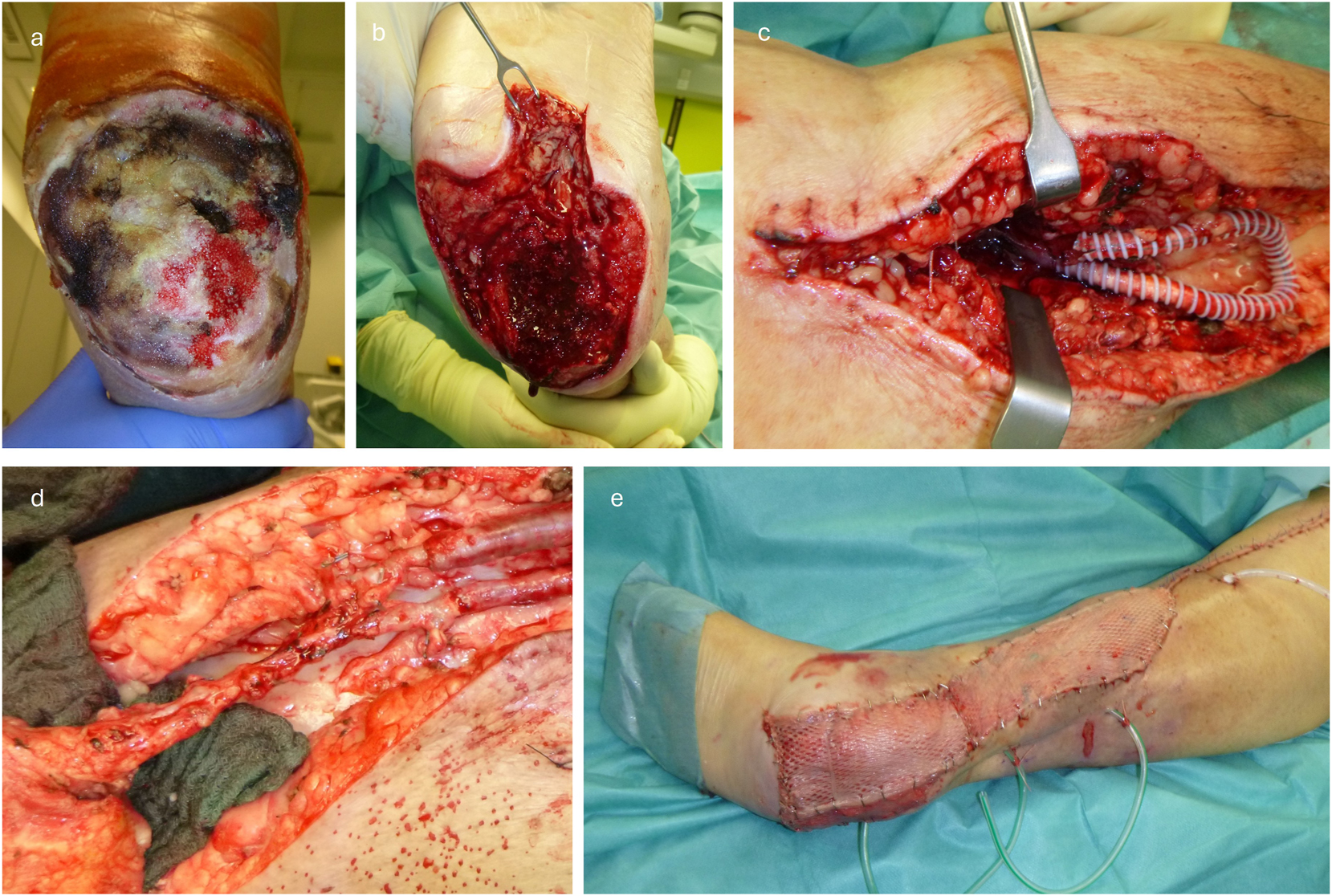 Figure 1: 
Exemplary demonstration of the surgical procedure for a) initial defect, b) after debridement c) after loop placement (enclosed by PTFE prosthesis for compression protection), d) after flap anastomosis and e) after final split skin grafting on the flap.