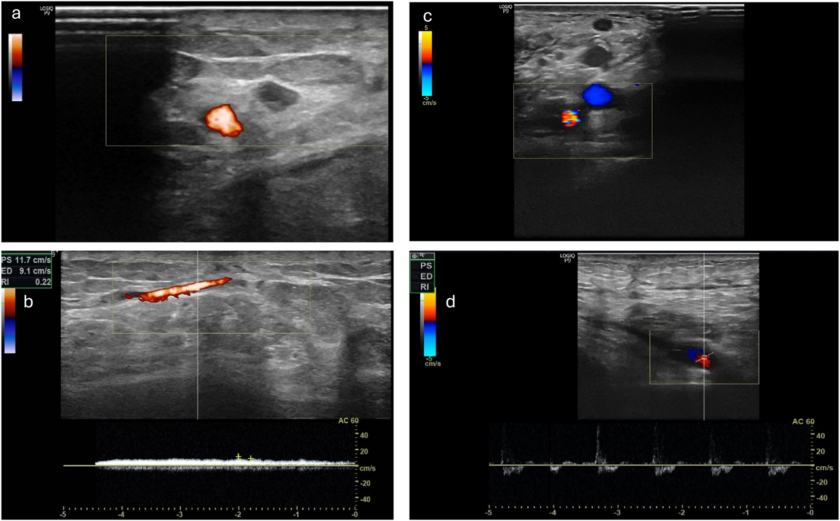 Figure 4: 
Left side a) and b) the venous leg of the loop is still patent, with a venous flow signal in the CW Doppler ultrasound while arterial leg is occluded (patient VII) right side c) and d) the AV-loop is still patent and both legs are still perfused with an arterial flow signal in the CW Doppler (patient XII).