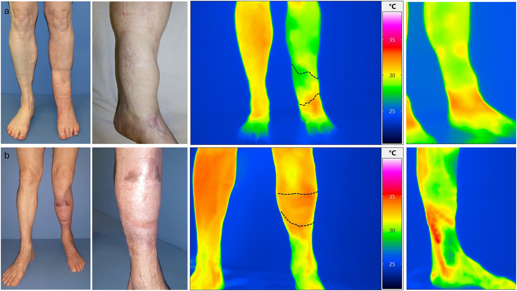 Figure 6: 
a) Upper row images of patient XI (occluded loop) and b) lower row patient XII (open loop) with native image and thermographic images in standing position.