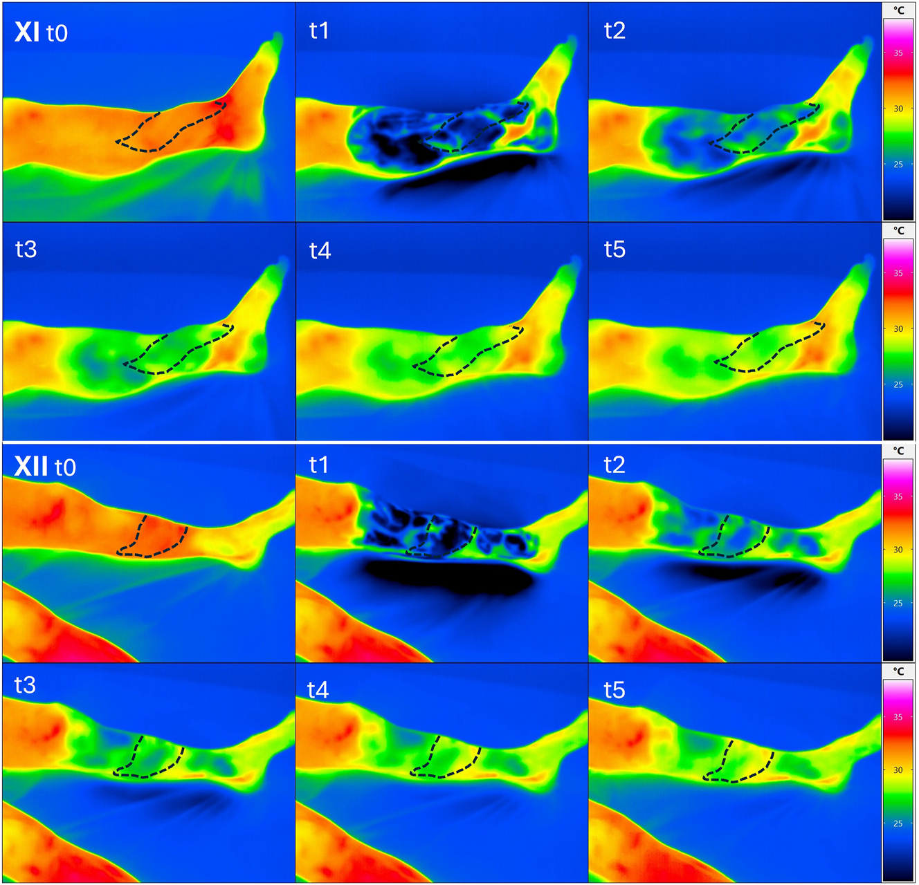 Figure 7: 
Upper image box: dynamic thermographic images of patient XI (closed loop) at the beginning (t0) after cooling for 90 s (t1) and subsequently after 2.5 min (t2), after 5 min (t3) after 7.5 min (t4) and after 10 min (t5). No difference in warming of the flap area compared to the proximal soft tissue with rewarming of the flap beginning from distal. Lower image box: dynamic thermographic images of patient XII (open loop) at the beginning (t0) after cooling for 90 s (t1) and subsequently after 2.5 min (t2), after 5 min (t3), after 7.5 min (t4) and after 10 min (t5). Visibly faster warming in the area of the inserted flap (middle tibia) compared to the distal and proximal tissues.