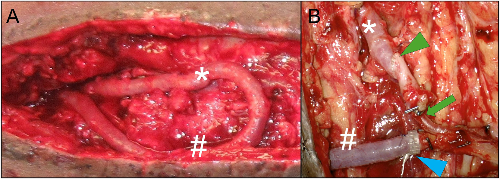 Figure 8: 
A) AV-loop exposure during flap procedure in situ, prior to dissection into arterial (*) and venous (#) leg B) after dissecting the AV-loop into arterial (*) and venous (#) leg and anastomosis of a free latissimus dorsi muscle flap: for the arterial anastomosis (green arrowhead), compensation of mismatch between arterial loop leg and subscapular (pedicle) artery is achieved by asymmetrical beveling of the two vessel endings (less beveling of the larger diameter AV-loop artery than the smaller diameter flap pedicle artery). Further tapering of the arterial inflow vessels occurs at the transition into the smaller caliber thoracodorsal artery (green arrow); venous anastomoses (blue arrowhead) is performed via 4.0 mm flow coupler device (Synovis Micro Companies Alliance, Inc., AL, USA).