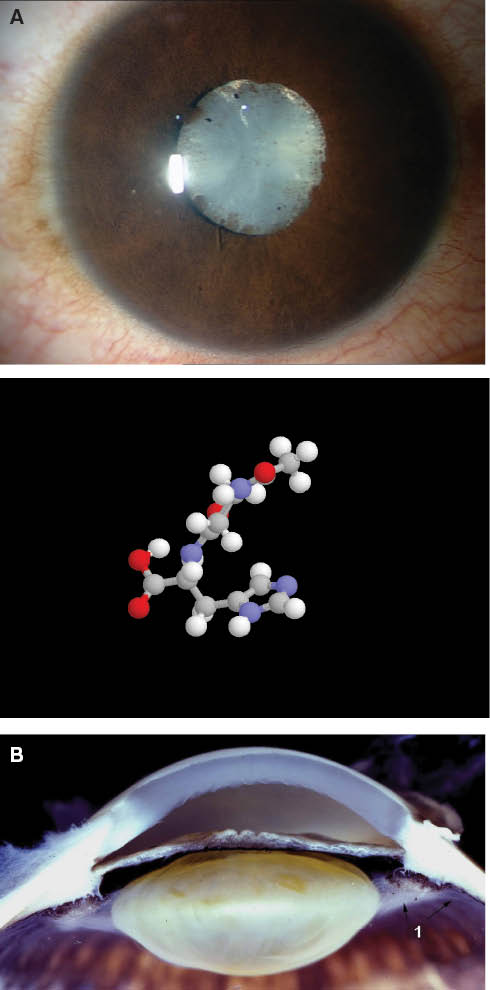 Figure 1 N-acetylcarnosine lubricant eye drops as a therapeutic tool and powerful platform to manage human cataracts.(A) Tissue damage due to oxidative stress has been implicated in aging, memory loss, and cataract formation as a biomarker of human senescence. The age-specific rates of age-related cataract for a group of 100 (50 males, 50 females) elderly persons who reached at least age 90 years with preserved cognition were compared to the corresponding rates of age-related cataract reported in five population-based studies. The principal finding was that persons who achieved exceptional longevity with preserved cognition (successful aging) group manifested a significant reduction in the age-specific rate and lifetime cumulative incidence of age-related cataract compared to the general population [13]. The findings suggest that the progressive development of lens opacities may be reflective of degenerative events occurring more generally throughout the body [13]. Carnosine, released ophthalmically from N-acetylcarnosine prodrug lubricant eye drops, at physiological concentration might remarkably reduce the rate of telomere shortening in the lens cells subjected to oxidative stress in the lack of efficient antioxidant lens protection (B). The data of visual functions (visual acuity, glare sensitivity) in older adult subjects and older subjects with cataract treated with 1% N-acetylcarnosine lubricant eye drops showed significant improvement compared, in contrast to the control group that showed generally no improvement in visual functions, with no difference from baseline in visual acuity and glare sensitivity readings [14, 15].
