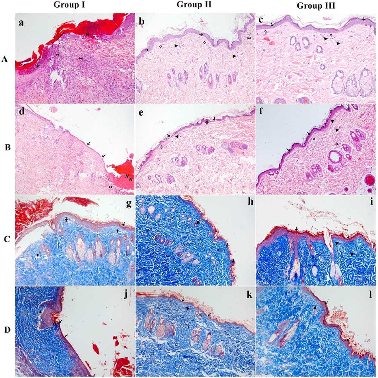 Figure 3: 
Representative histological images of flap tissues from each group. (A, B) Sections stained with Hematoxylin & Eosin (H&E) to assess epithelial structure, granulation, inflammatory infiltration, and neovascularization. (C, D) Sections stained with Masson’s trichrome to visualize collagen deposition and connective tissue organization. (A, C) Proximal regions of the flap. (B, D) Distal regions of the flap. Arrows and symbols indicate key histological findings: ➔ epithelial regeneration, ❖ granulation tissue, ⟡ fibroblast proliferation, ► neovascularization, ⧓ presence of inflammatory cells, ⧱ decreased collagen density, 

Ν

 necrosis. Group I: control; group II: MLT; group III: LSE.
