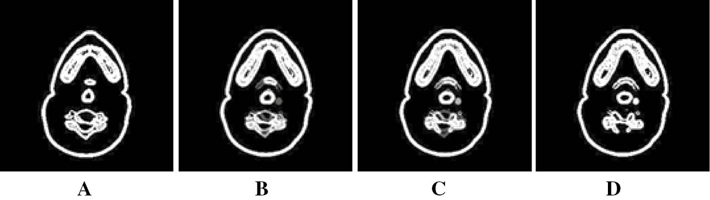 Figure 5: Re-creation of slices using REG based interpolation. (B and C) are re-created slices by applying REG based interpolation to the selected segmented slices (A and D).