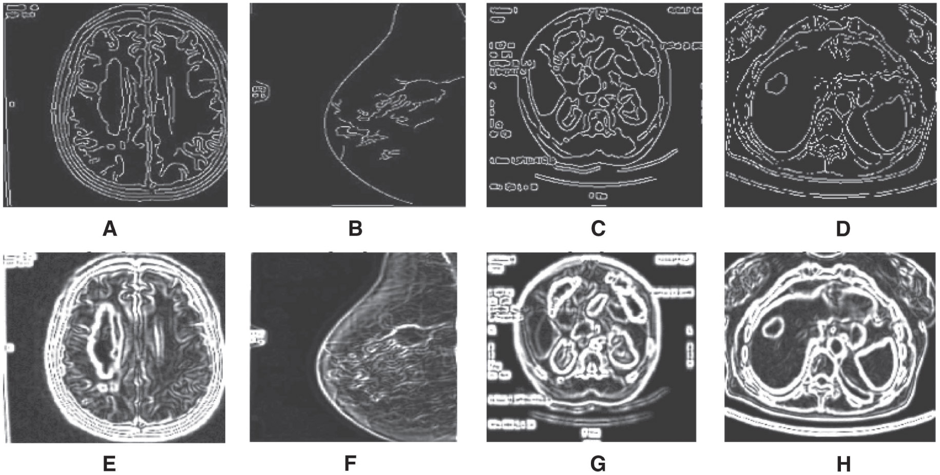 Figure 4: Edge Detection Algorithms for Boundary Detection in Medical Images; (A–D) Canny Edge Detector Output, (E–H) Gauss Gradient Edge Detector Output.