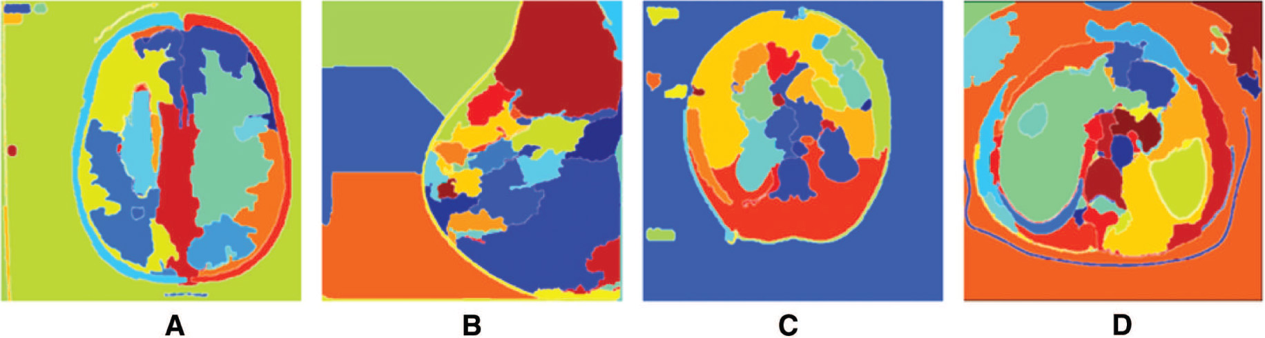 Figure 5: Topographical Watershed Map for Medical Images; (A–D) Gradient-Based Watershed Segmentation Outputs.