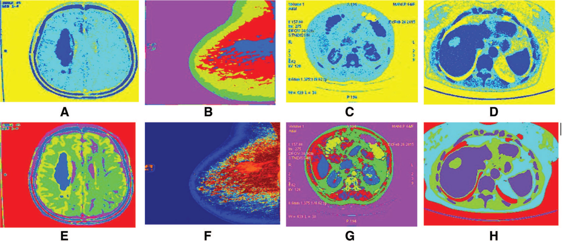 Figure 6: Clustering Algorithms for Region Extraction in Medical Images; (A–D) FCM Segmentation Results, (E–H) FLICM Segmentation Results.