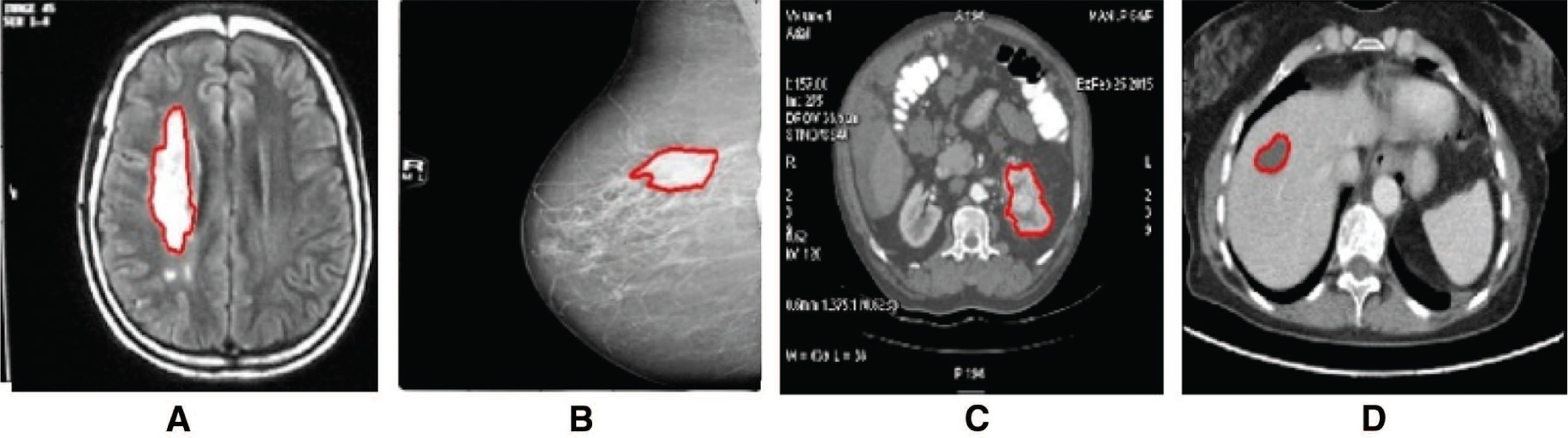 Figure 7: Deformable Model for Tumor Boundary Extraction in Medical Images; Lankton Active Contour Segmentation Results.