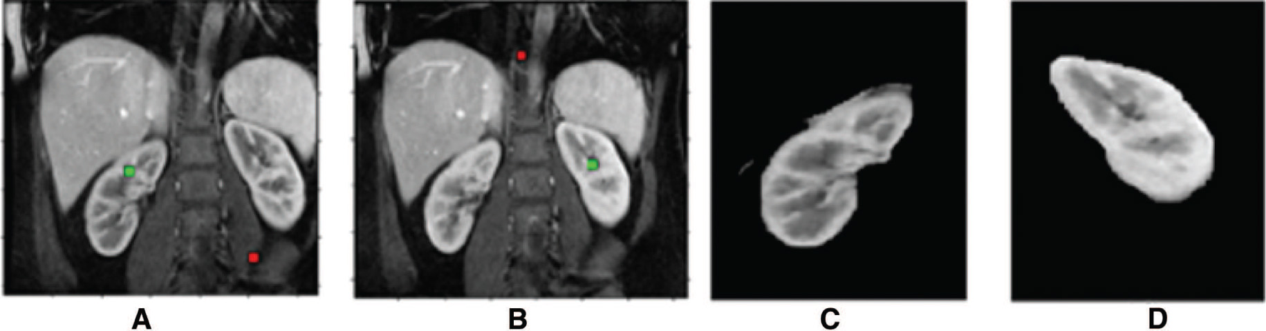 Figure 8: Graph Cut Algorithm for Anatomical Organ Delineation; (A, B) Input Images with Seed Point Selection, (C, D) Graph Cut Segmentation Result.
