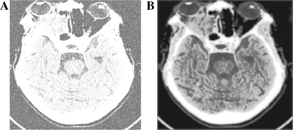Figure 8: Analysis of Visual Quality of Restored Medical Image 1 (Gaussian Noise in σ = 50%).
(A) Noisy image, (B) restored image.