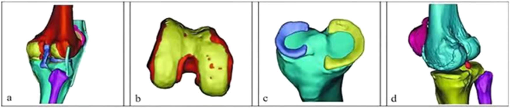 Figure 5 
                  3D anatomical model of OA knee joint: (a) model assembly, (b) distal femur model, (c) proximal tibia model, and (d) knee joint bone model.
               