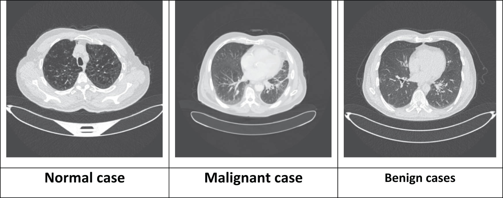 Figure 4 
                  Sample of three types of CT SCAN of patients in classification operation.
               
