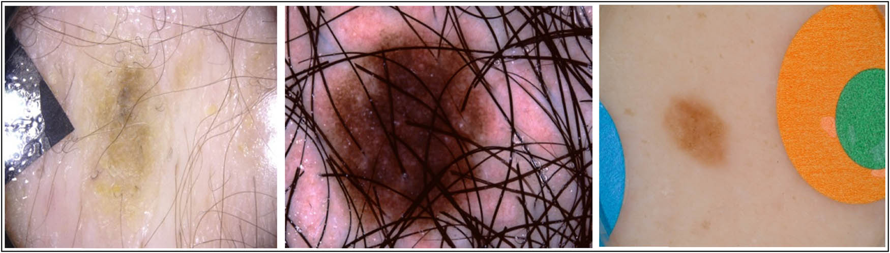 Figure 7 
                  Examples of limitations in the ISIC archive dataset.
               