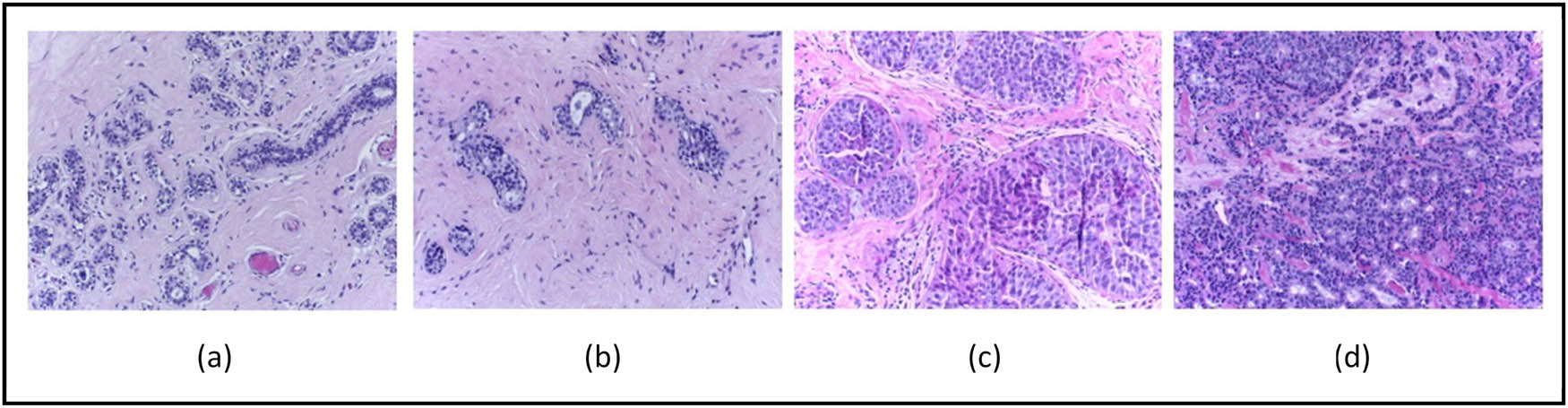 Figure 8 
                  Samples from the BACH2018 dataset [91]. (a) Normal, (b) benign, (c) in situ, and (d) invasive.
               