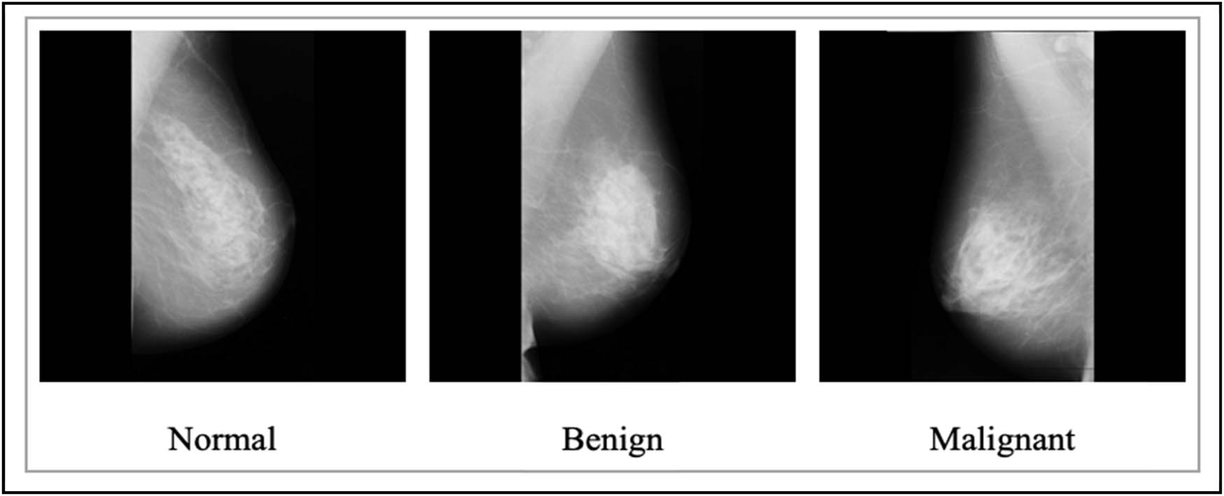 Figure 9 
                  Mammography images from the MIAS dataset [113].
               