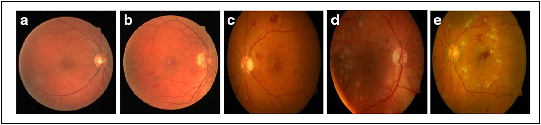 Figure 10 
                  Images from the APTOS 2019 dataset. (a) Normal image, (b) mild DR, (c) moderate DR, (d) severe DR, and (e) proliferative DR.
               