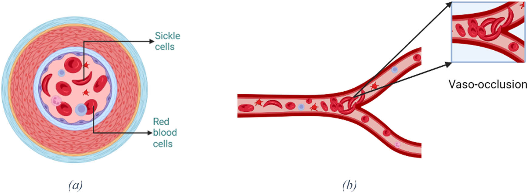 Figure 1
(a) Appearance of sickle cells and red blood cells and (b) sickle cell causing vaso-occlusion.