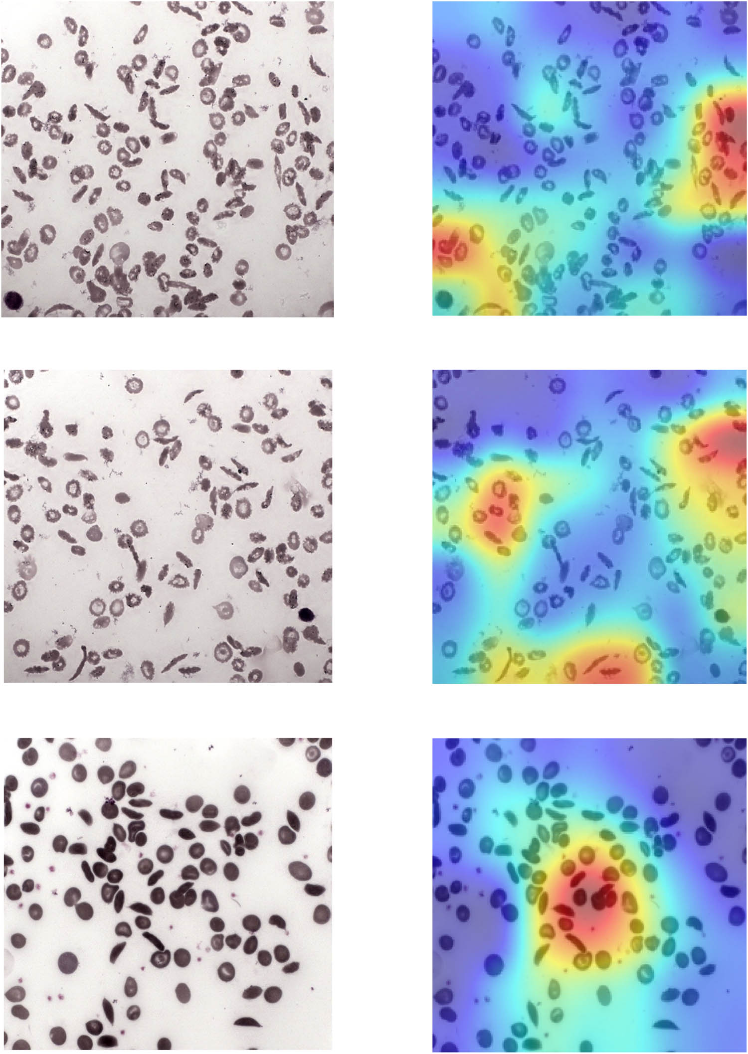 Figure 13
Sickle cell images under Grad-CAM.