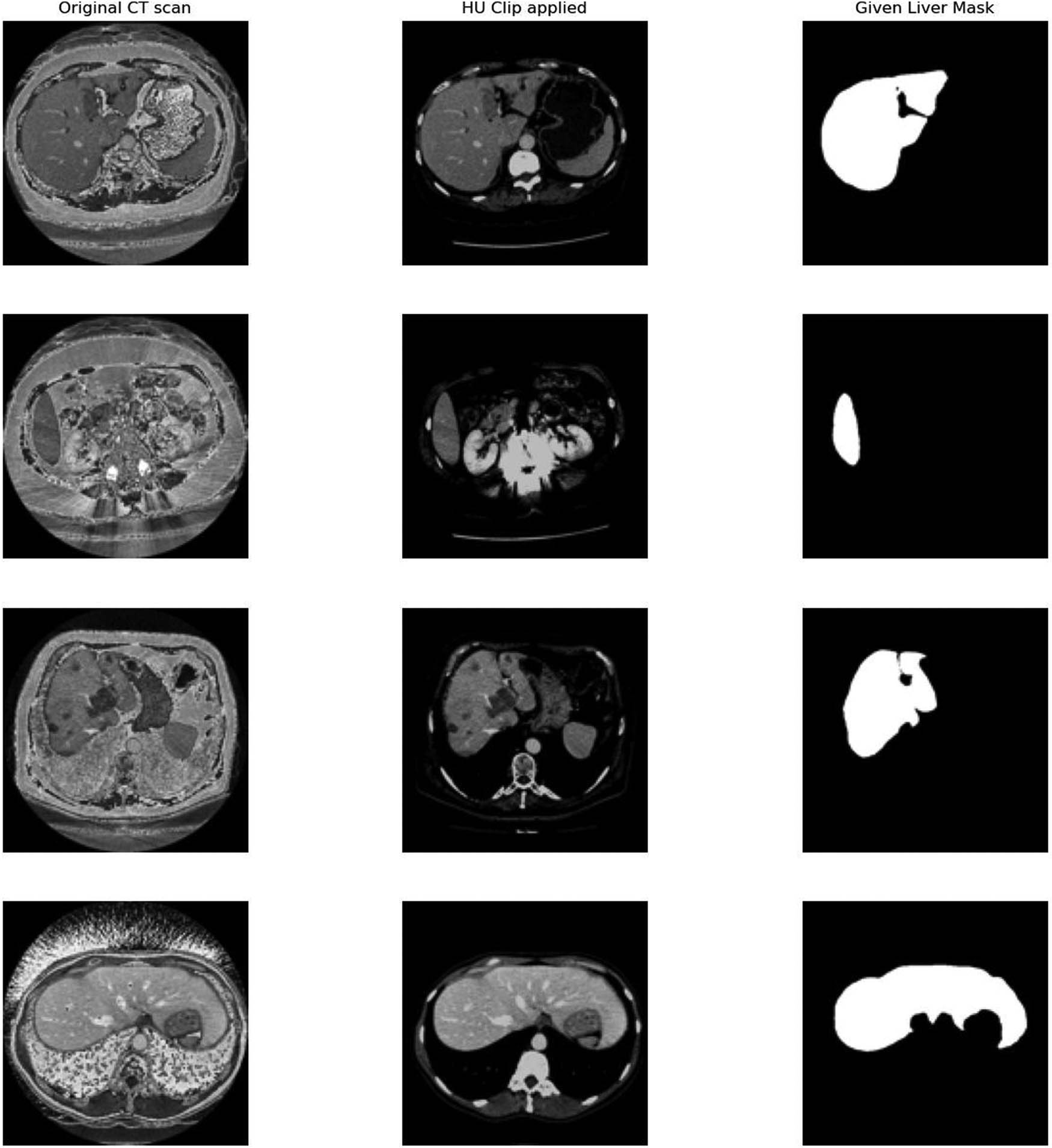 Figure 3 
                  Visualization of the datasets – Column 1: Original CT scans, Column 2: HU-clipped CT images, and Column 3: Given liver masks. The images are examples from publicly available datasets (3DIRCADb, CHAOS, and LiTS) used in this study, where the first and second image is from 3DIRCADb, the third image is from CHAOS and the fourth image from LiTS.
               