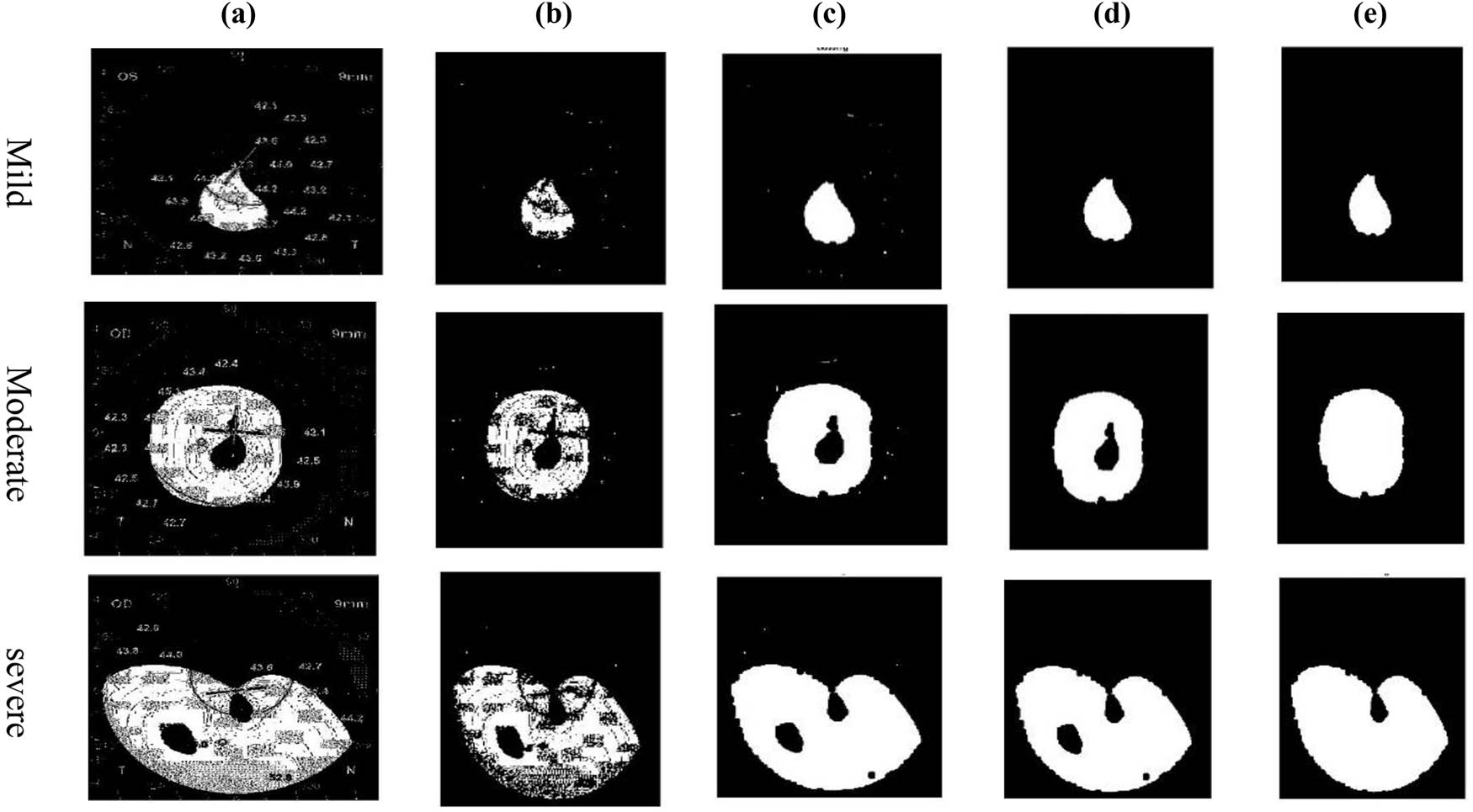 Figure 4
Morphological techniques for cases: (a) extracted, (b) opening, (c) closing, (d) largest object, and (e) hole filling.