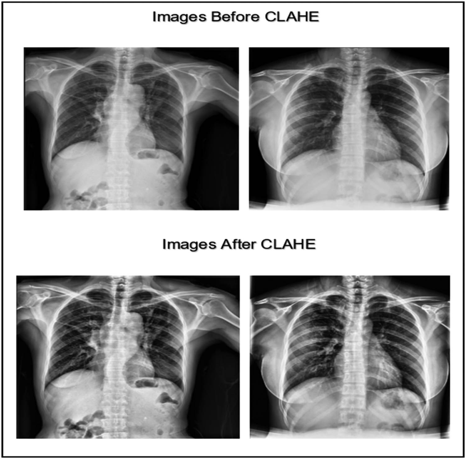 Figure 2 
                  CXR images before and after applying the CLAHE enhancement technique (created by the authors).
               