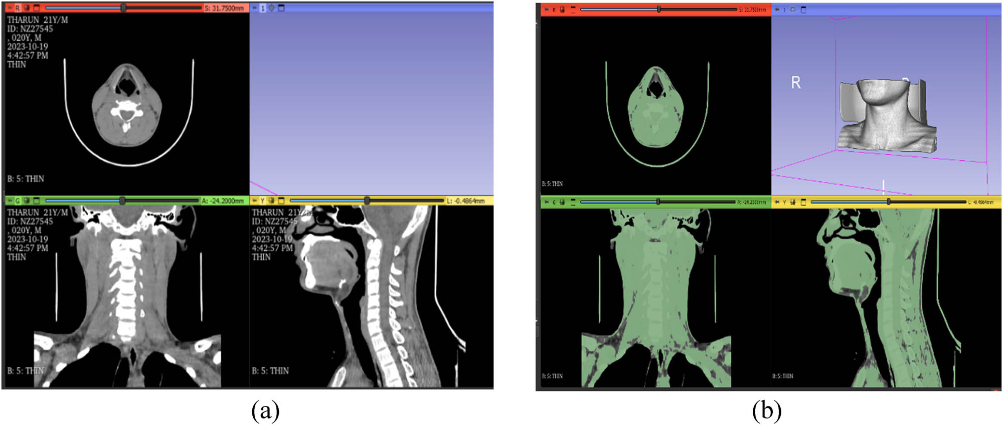 Figure 3 
                     Cervical spine (a) DICOM format of CT scan images, and (b) cervical region in thresholding range.
                  