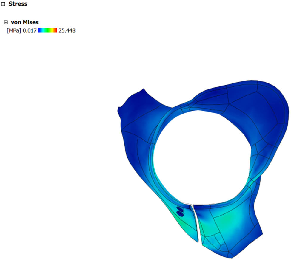 Figure 12 
                     Stress (von Mises) distribution in the cervical collar.
                  