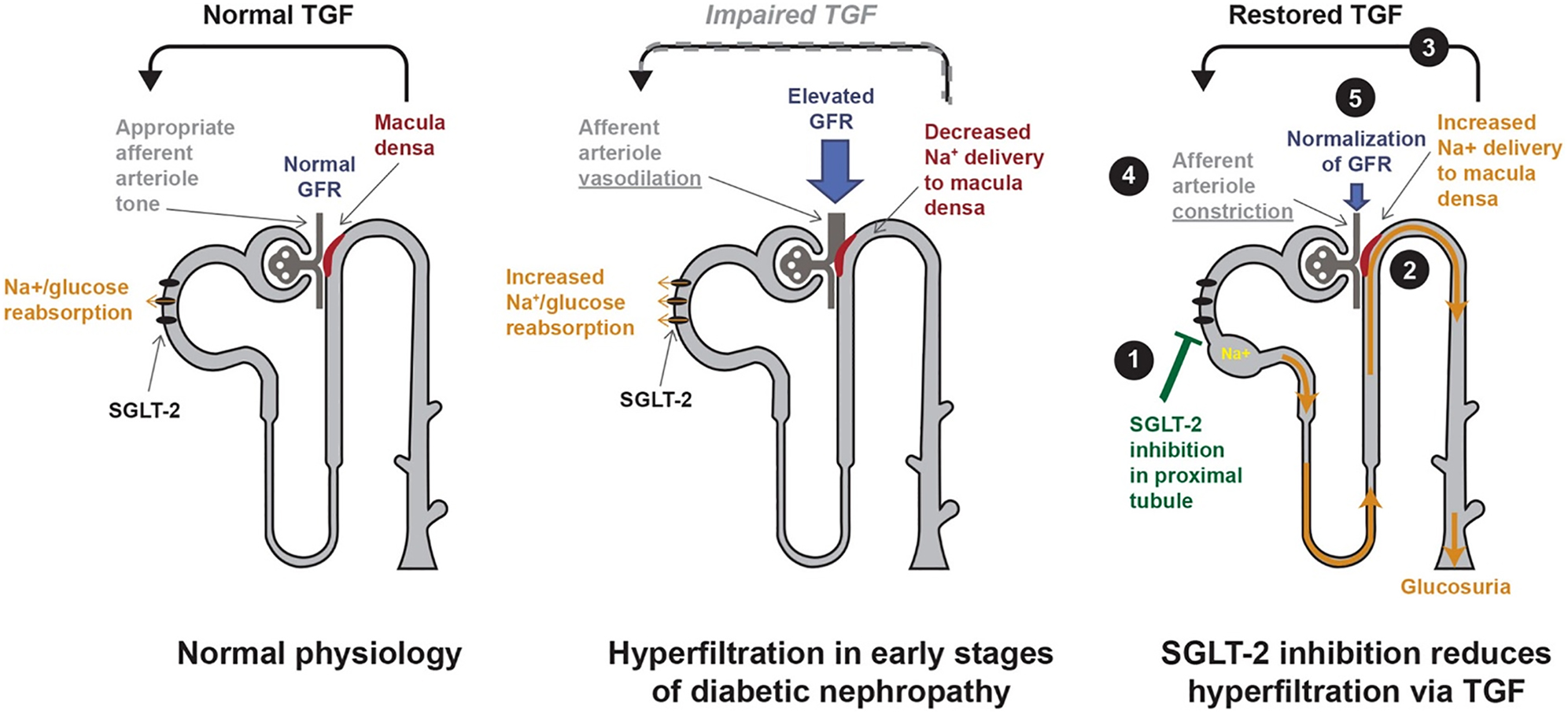 Figure 2: SGLT2 inhibitors: renal hemodynamic effects. TGF: Tubuloglomerular Feedback. Reproduced with permission from John Wiley and Sons. Chilton RJ. Effects of sodium-glucose cotransporter-2 inhibitors on the cardiovascular and renal complications of type 2 diabetes. Diabetes Obes Metab. 2020;22(1):16-29. doi:%2010.1111/dom.13854.
