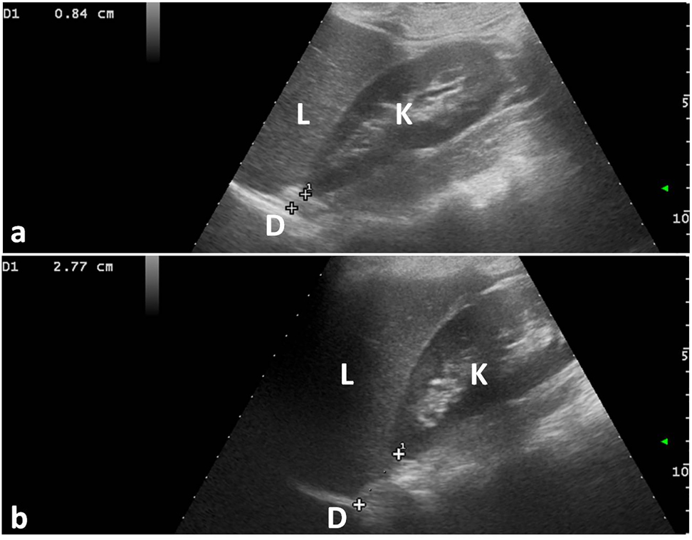 Figure 6: Ultrasound measurement T1. The distance between the superior pole of the right kidney and the origin of the respective diaphragmatic pillar (calipers) was calculated during (a) maximal inspiration and (b) maximal expiration. K, right kidney; D, diaphragmatic pillar; L, liver.