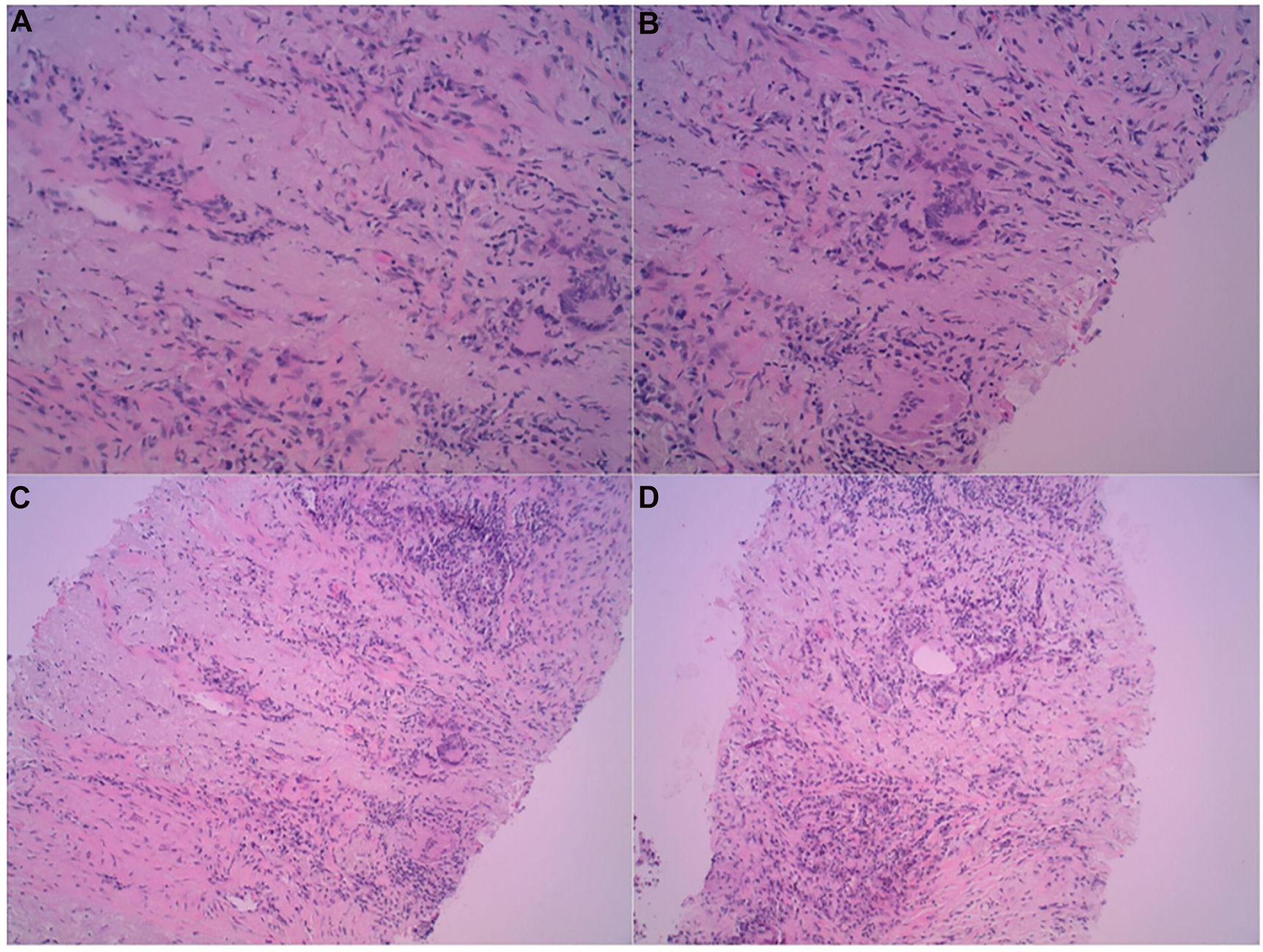 Figure 3: 
(A–D) Histology slides of needle core biopsies. The slides demonstrate fibrosis and scarring accompanied by mixed chronic inflammation and focal noncaseating and necrotic sites of granulomatous inflammation.
