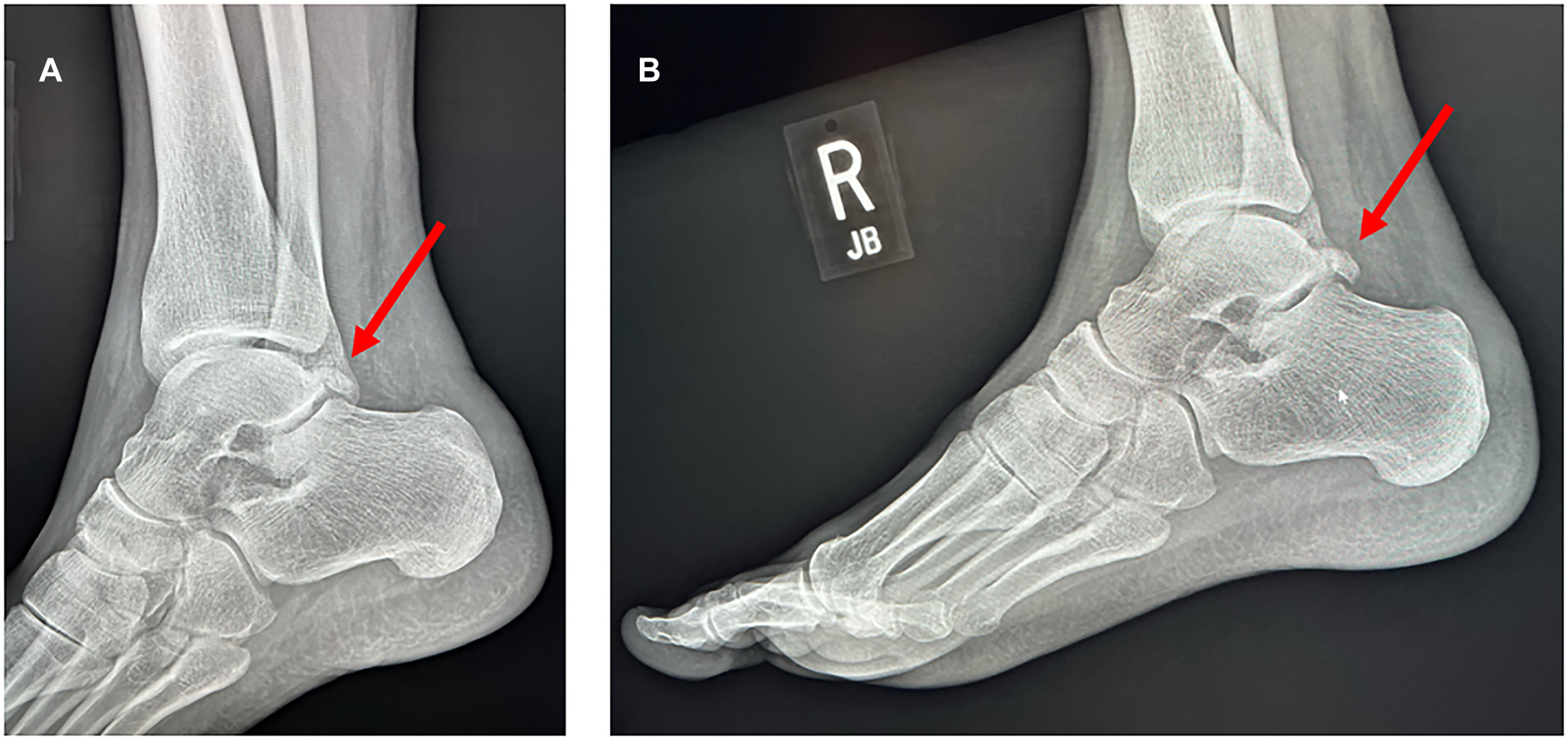 Figure 1:
(A) X-ray of the patient’s right ankle (oblique view). (B) X-ray of the patient’s right ankle (lateral view).