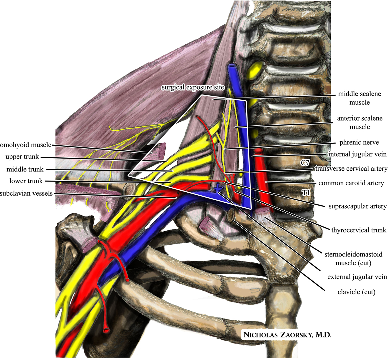 Figure 2: 
An illustration of the relevant neurovascular anatomy in the anterior supraclavicular neurosurgical approach to the brachial plexus and subclavian vessels for thoracic outlet syndrome. This file is licensed under the creative commons Attribution-ShareAlike 3.0 Unported license. Source: Nicholas Zaorsky, MD. Zaorsky, M. Thoracic outlet. https://commons.wikimedia.org/wiki/File:Wikipedia_medical_illustration_thoracic_outlet_syndrome_brachial_plexus_anatomy_with_labels.jpg.
