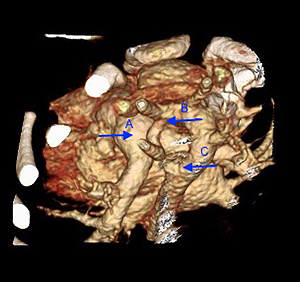 Figure 1: 
A 3D CTA demonstrates a double aortic arch with a dominant right aortic arch. There is a focal short segment of atresia involving the mid-portion of the left aortic arch and narrowing of the trachea. (A) Trachea, (B) atresia of the left aortic arch, and (C) dominant right aortic arch.
