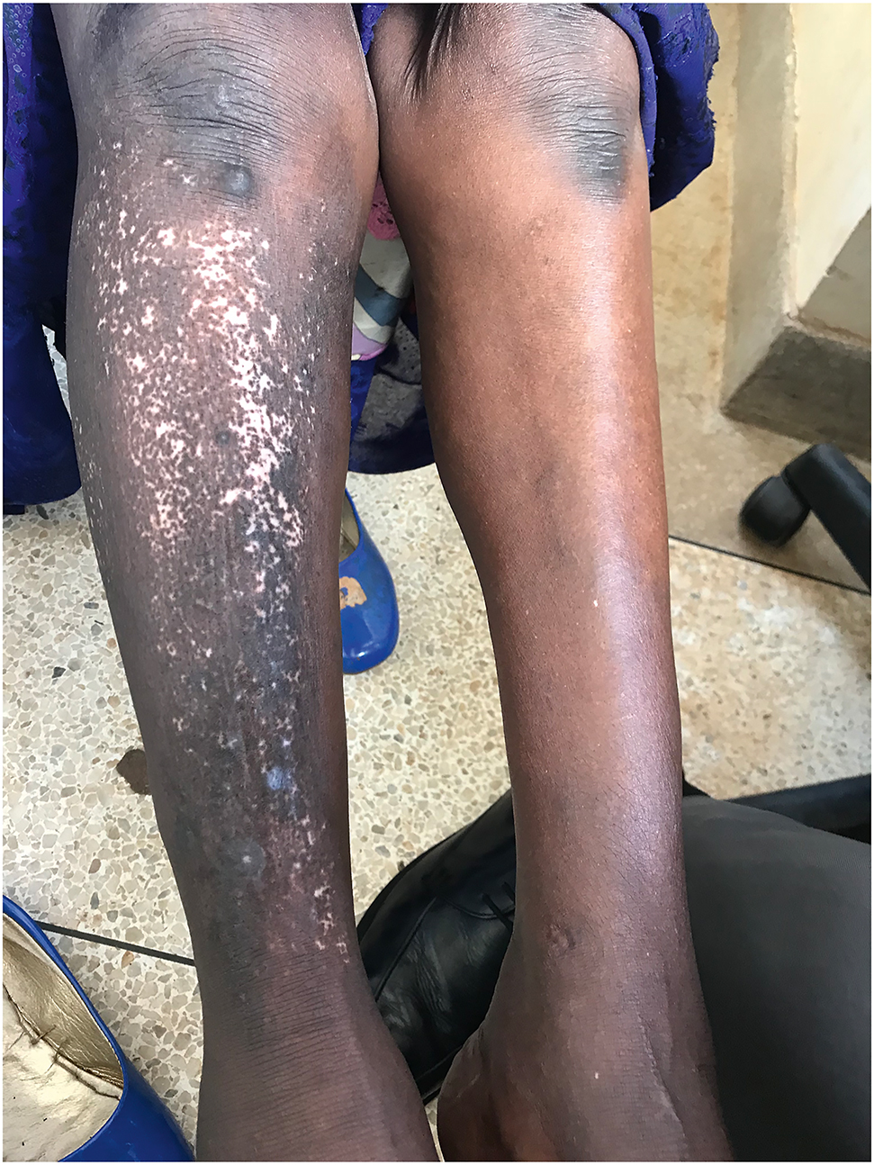 Figure 1: 
Diffuse depigmentation with follicular sparing on the lower right dorsal distal extremity.
