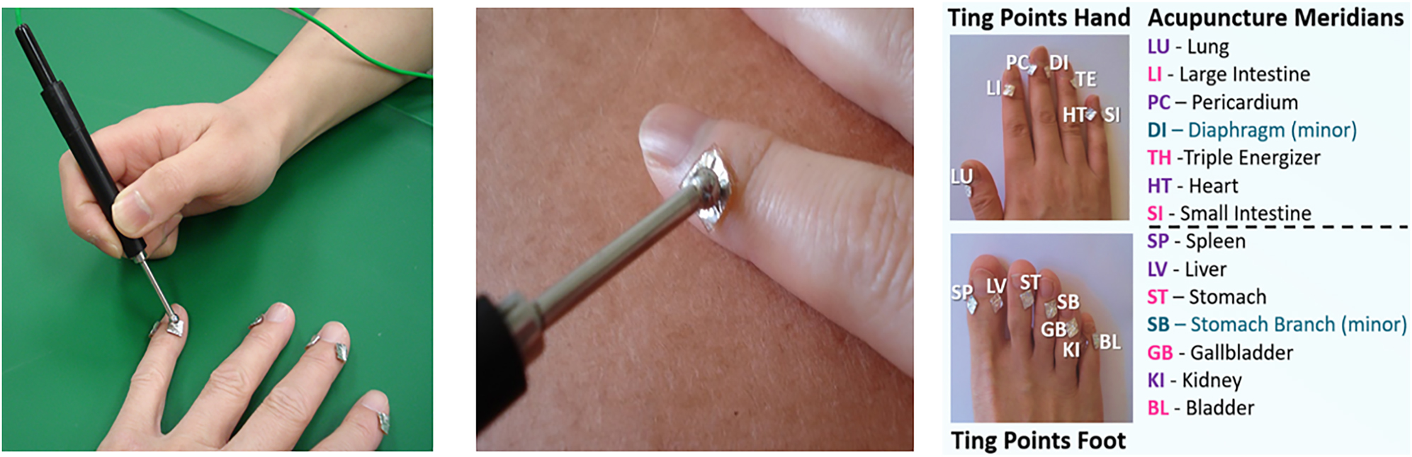 Figure 3:
The two left images show the placement of the 7 × 7 mm metal active electrode patches at the Ting points on the hand. The probe electrode is placed on the metal patches and distributes a 3 V DC pulse for 512 µsec. Each Ting acupoint measured in this study is indicated in the image on the right. (Photos courtesy of California Institute for Human Science, Encinitas, CA).