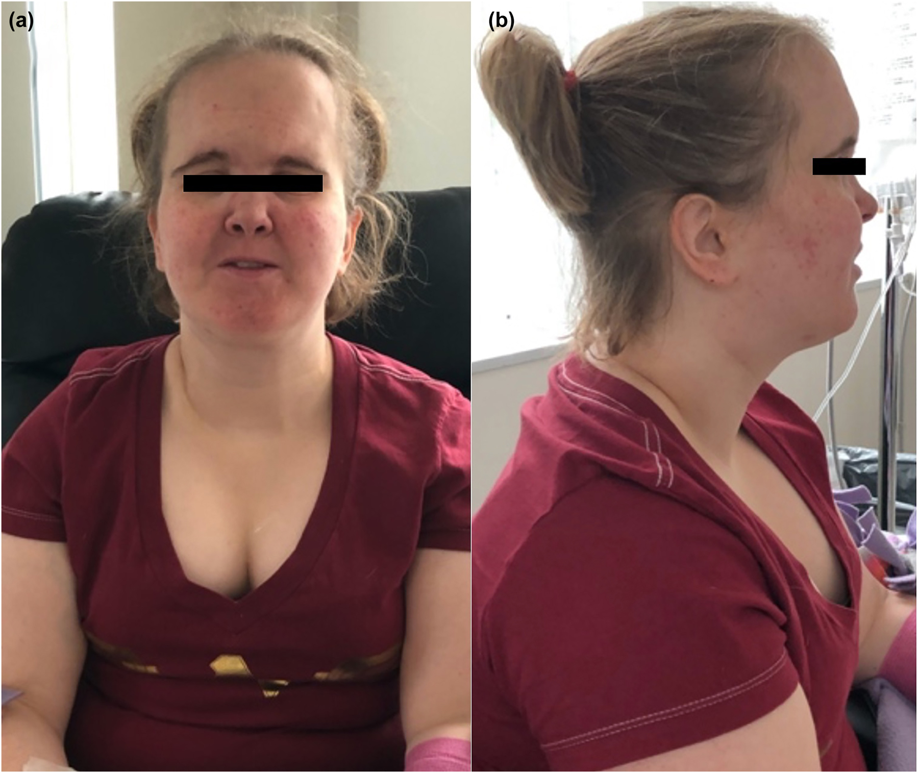 Figure 1: 
Craniofacial presentations of a 28-year-old female patient with phosphatidylinositol 3-kinase regulatory subunit 1 (PIK3R1) mutation. (A) Anterior view. (B) Lateral view.
