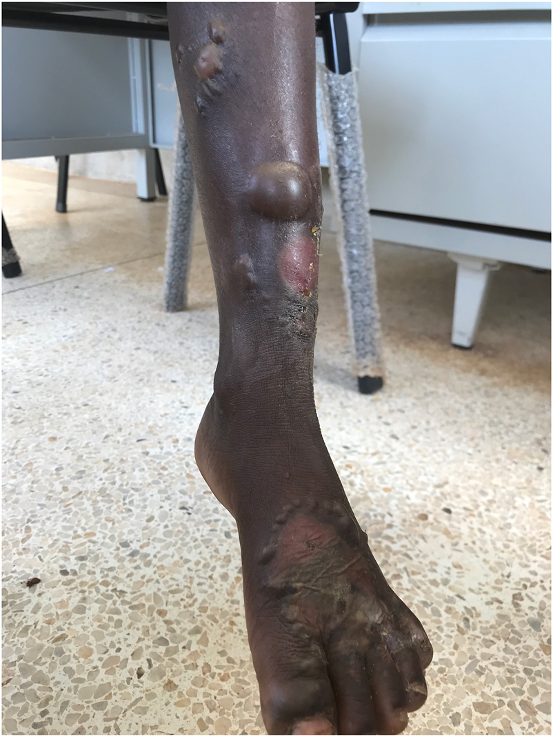 Figure 1:
Urticarial plaques and numerous tense bullae in an annular arrangement on the lower left leg and foot.