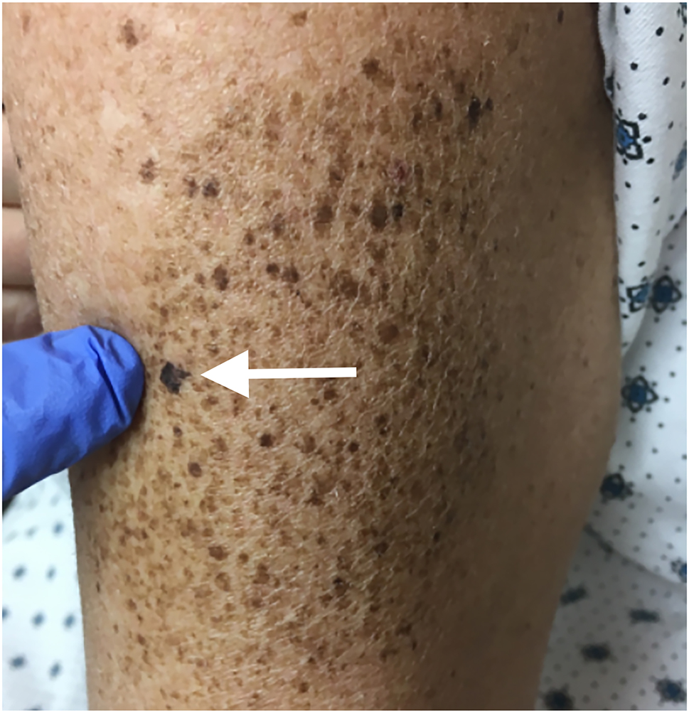 Figure 1: 
A superficial spreading melanoma within a nevus spilus presented on the left lateral arm. The white arrow points to the suspicious lesion within the nevus spilus, which was proven through biopsy to be a superficial spreading melanoma.
