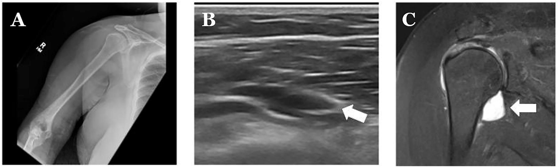Figure 1:
Radiographic evaluation of the right shoulder. (A) Normal X-ray without bony or soft-tissue abnormalities. (B) Abnormal point-of-care ultrasound (POCUS) evaluation of the right shoulder, with the arrow demonstrating tendon deficit. (C) Fluid MRI results, with the arrow showing rupture of the supraspinatus tendon with 1.8 cm stump retraction.