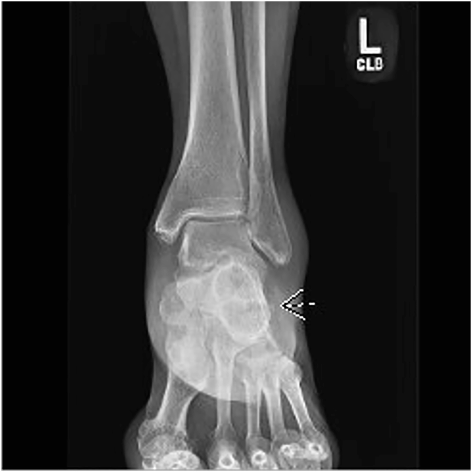 Figure 1: 
The anteroposterior X-ray of the left foot showing a nondisplaced avulsion fracture of the lateral calcaneus.

