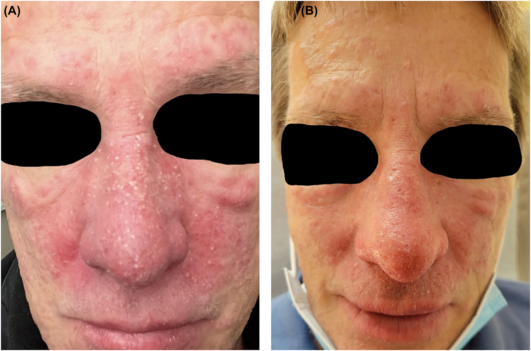 Figure 1: 
Rosacea flair with inflamed papules and pustules, (A) before and (B) after treatment.
