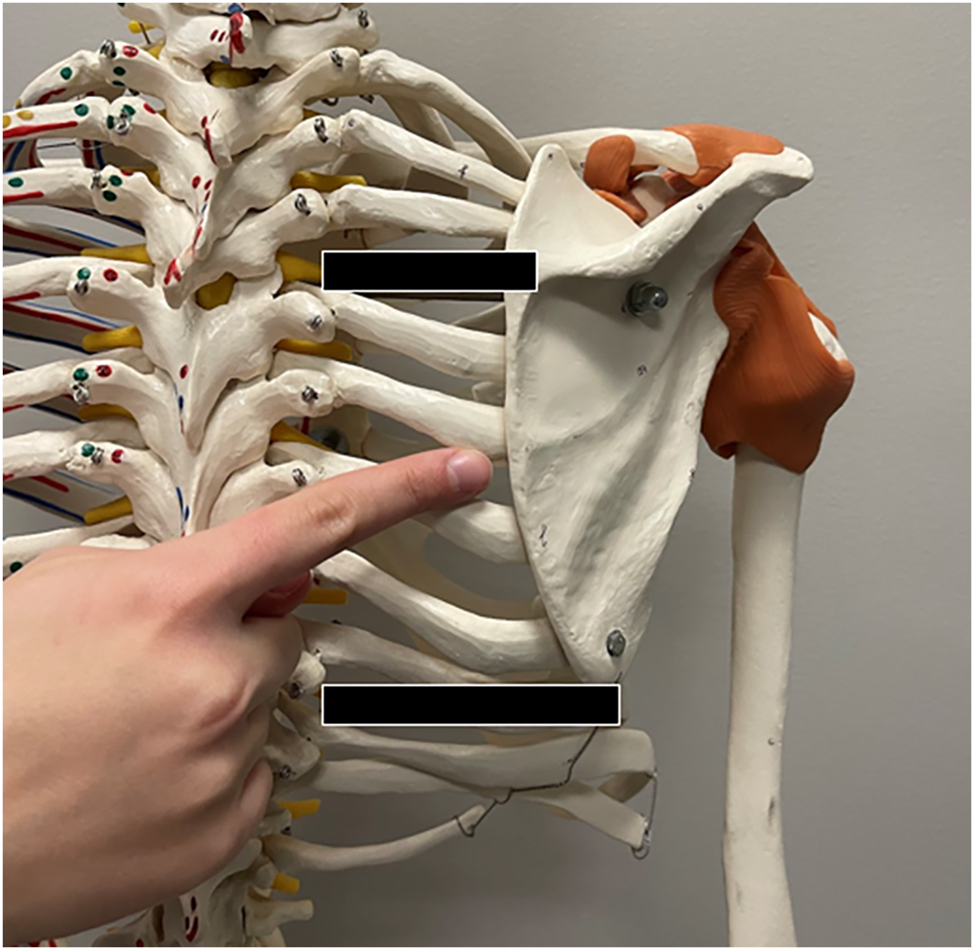 Figure 1:
The location of the tender point on the skeleton is found along the medial border of the scapula between the spine of the scapula and the inferior angle. The spine and inferior angle of the scapula are demarcated with the black bars.