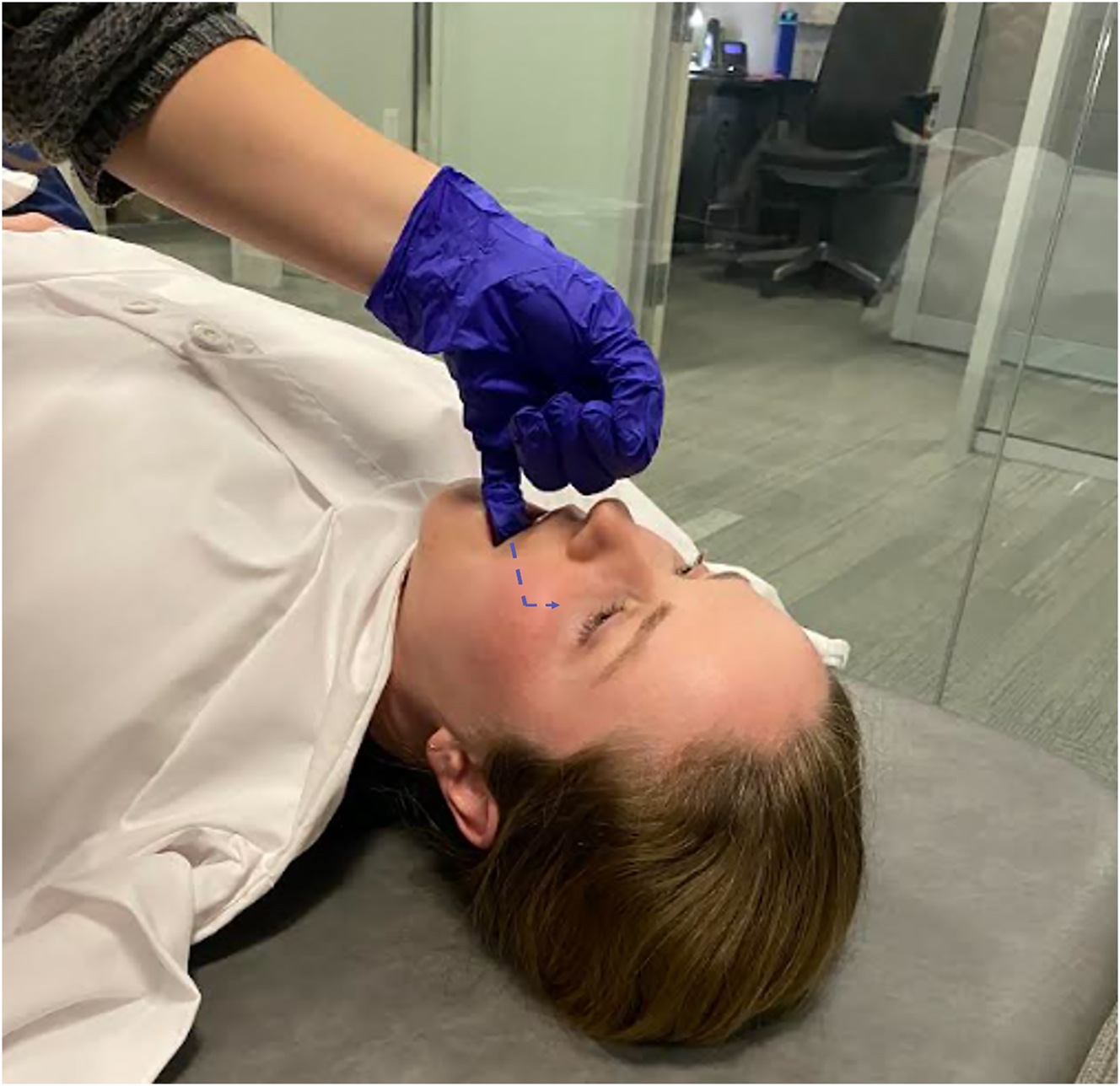 Figure 1:
To perform the SPG release, insert a gloved finger into the oral cavity. Run your fifth finger along the maxilla within the oral cavity, lateral to the molars, until your finger contacts the pterygoid plate at the posterior aspect of the mouth. Then, direct your pressure superiorly and provide a rotatory motion to stimulate the SPG.
