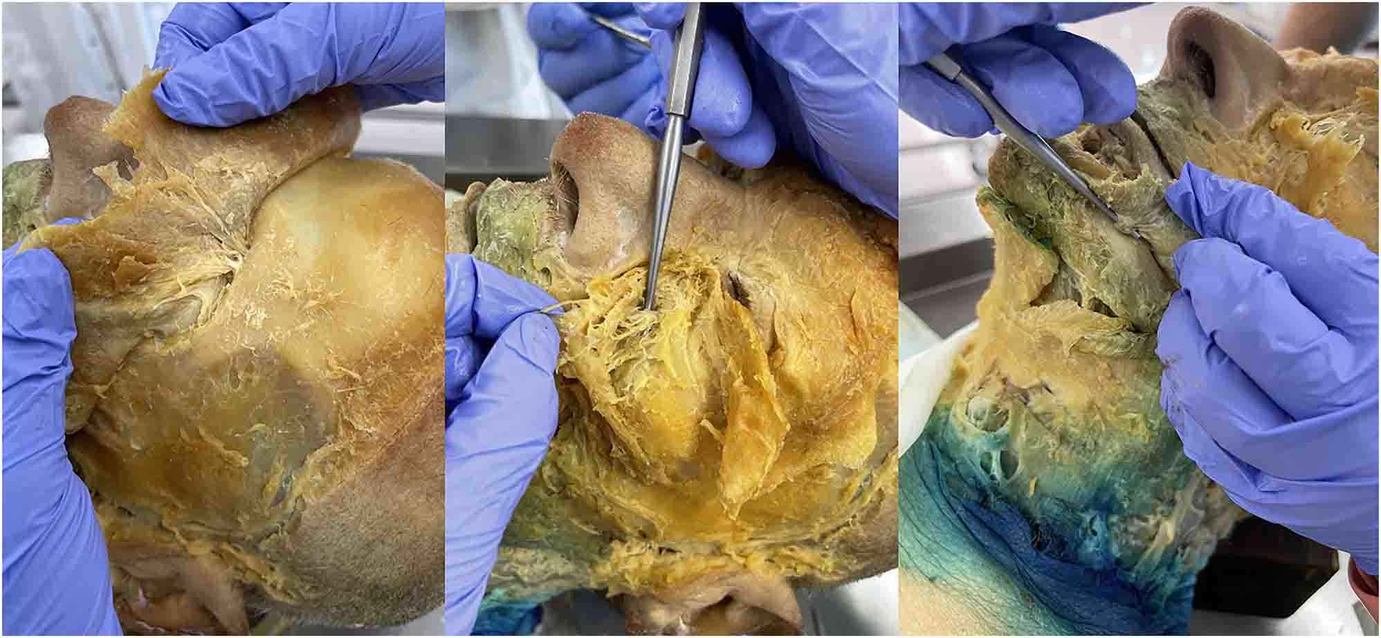 Figure 2:
After removing the skin and dissecting the muscles of facial expression, the main branches of the trigeminal nerve were identified. From left to right: supraorbital (branch of CN V1) through the supraorbital foramen, infraorbital (branch of CN V2) through the infraorbital foramen, and mental (branch of CN V3) through the mental foramen.