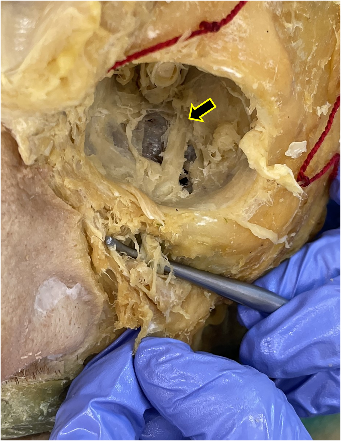 Figure 3:
After enucleating the eyeball, we followed the infraorbital nerve as it travels along the infraorbital groove and emerges from the inferior orbital fissure (black arrow). To the left of the image is the nose, the ear is positioned to the right, and the superior edge of the orbit is positioned at the top of the image. The probe shows the infraorbital nerve (branch of CN V2) emerging from the infraorbital foramen.