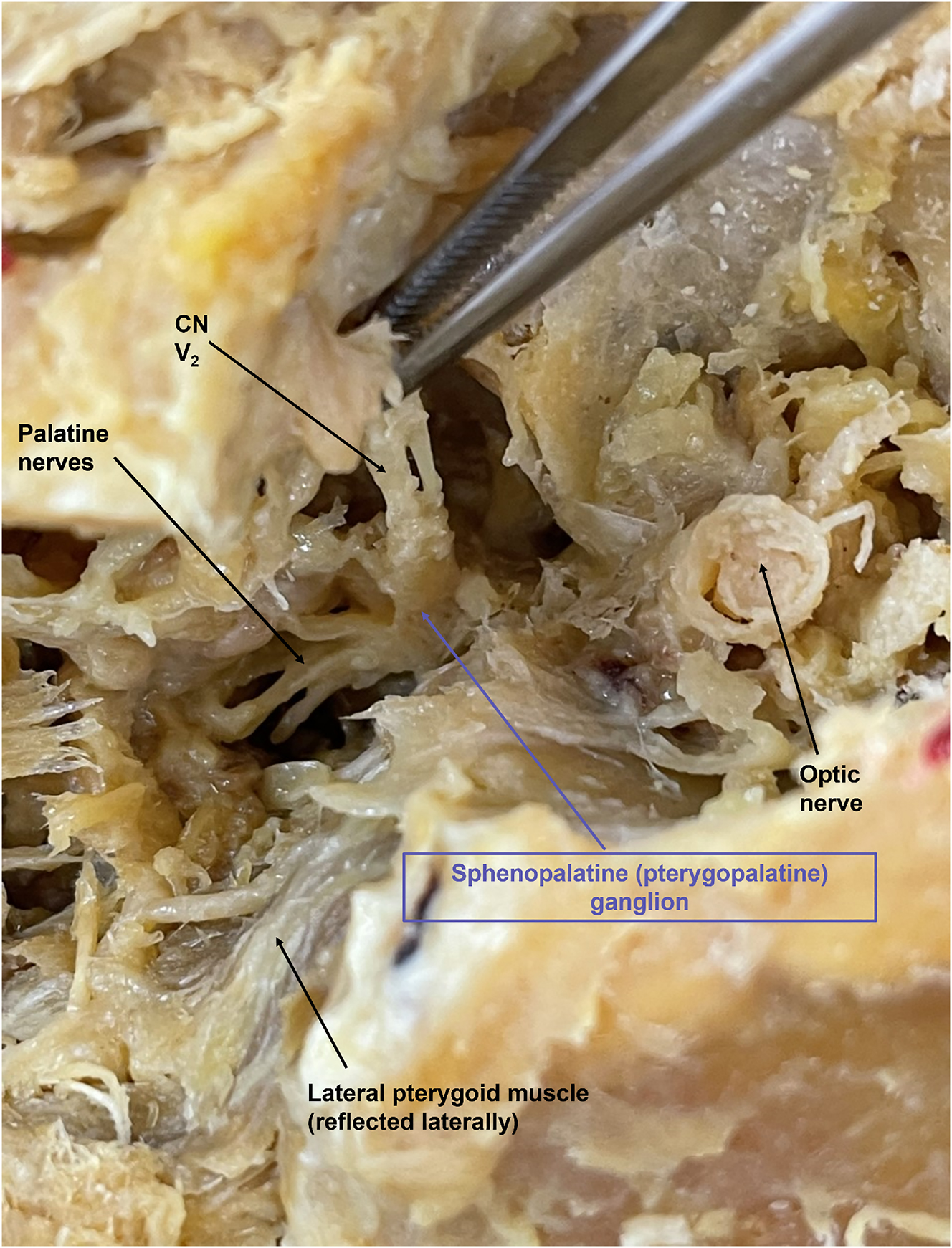 Figure 4:
The SPG is demonstrated with the purple arrow. CN V2 is seen branching anteriorly, with the palatine nerves branching inferiorly. The cut optic nerve is seen superiorly. To the left of the image is the nose, the ear is positioned to the right, the superior edge of the orbit is positioned at the top, and the cut zygomatic arch is positioned at the bottom of the image.