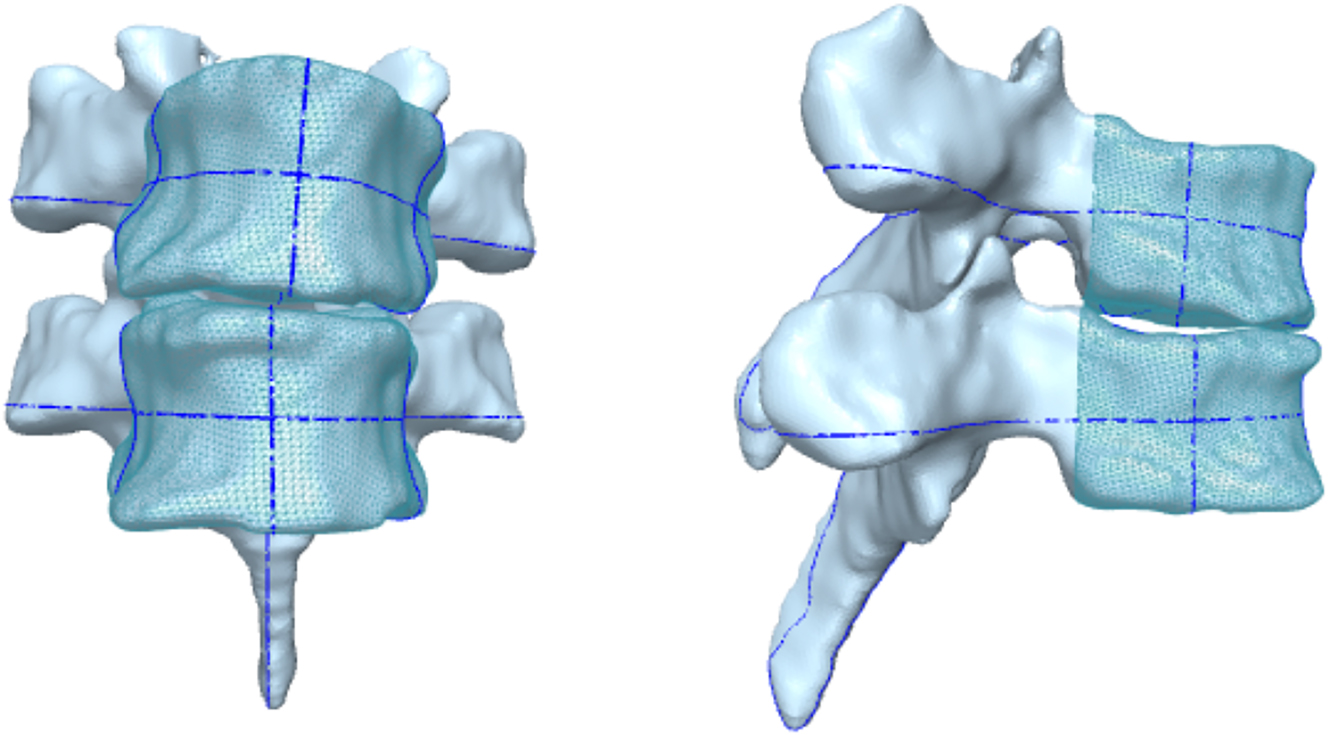 Figure 4: 
3D renderings of vertebral levels T3 and T4 from oblique coronal and sagittal views, demonstrating non-Fryette’s mechanics flexion: 2.4°, rotation: −2.5°, side-bending −3.9°. The wireframe region represents the separated vertebral body. The blue lines represent the symmetry planes of the vertebra.

